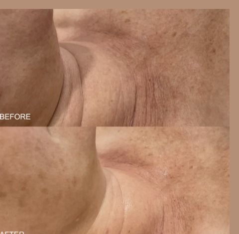 Before and after - B&A 1 Qi Beauty Facial